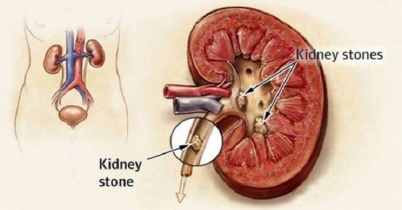 কিডনির পাথর থেকে বাঁচার ২ উপায়